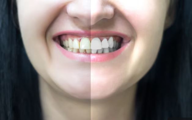 Teeth Cleaning vs. Teeth Whitening