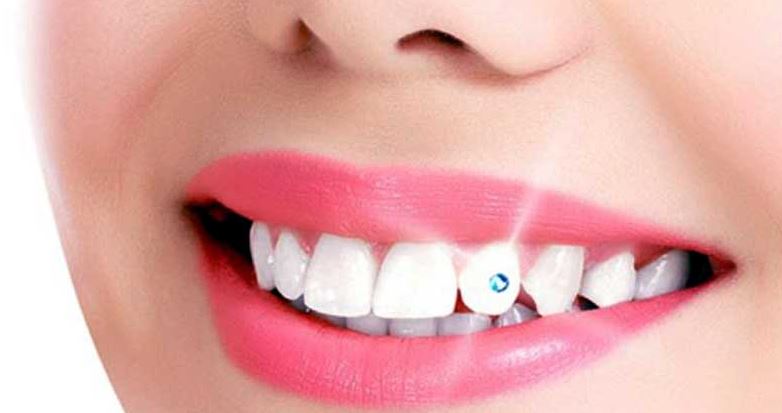 Tooth Jewelry Treatment