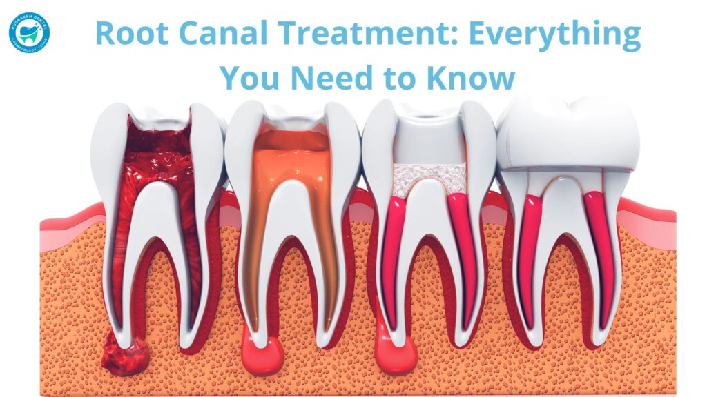 Understanding Root Canal Treatment Everything You Need to Know