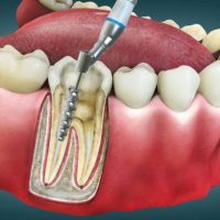 Root Canal Treatment In Bagphat