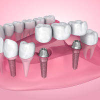 Dental Crown and Bridges