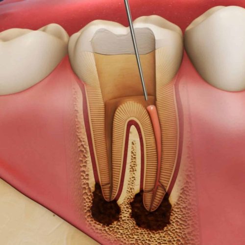 Root Canal Treatment baghpat